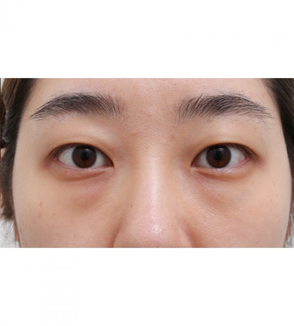 激光 眼底脂肪重…