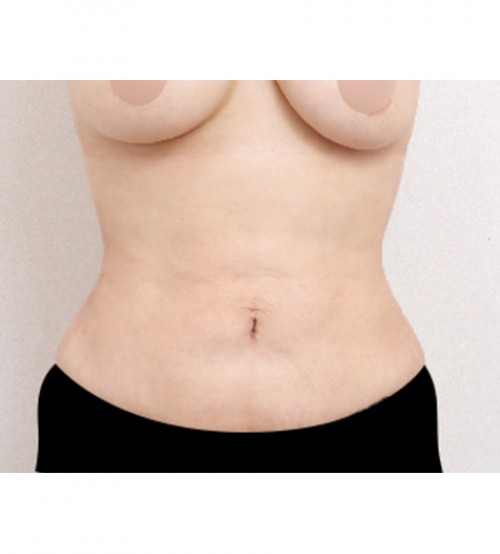 威塑2 身体吸脂