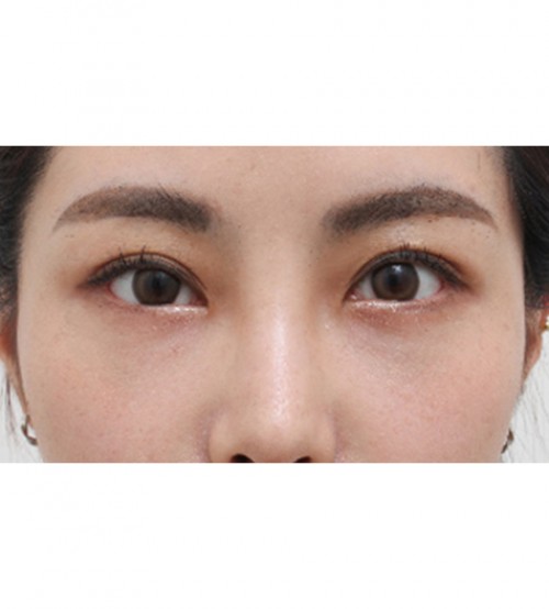 激光 眼底脂肪重置