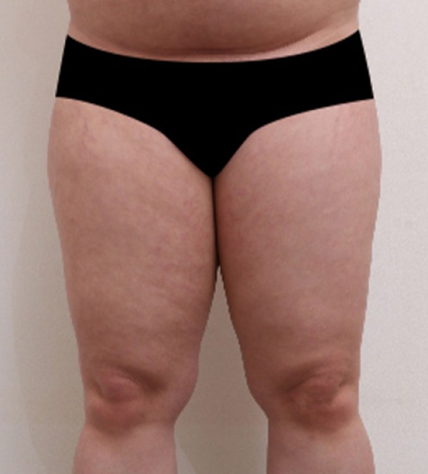 威塑2 身体吸脂