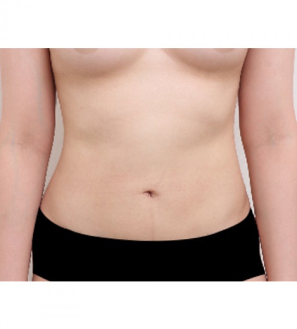 威塑2 身体吸脂