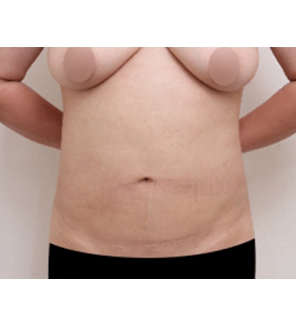 威塑2 身体吸脂