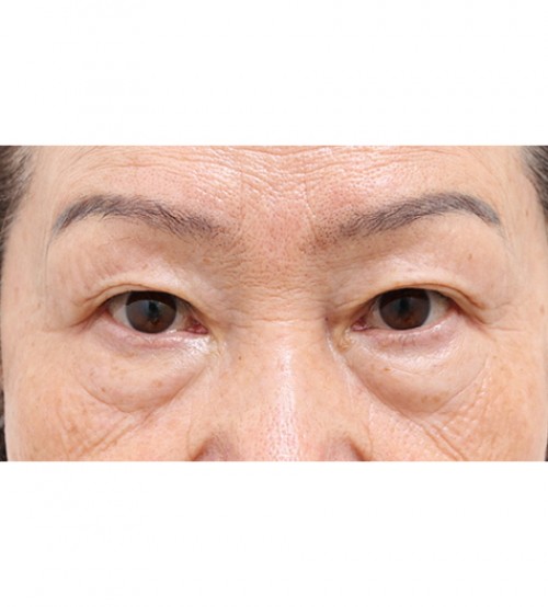 中年眼部整形