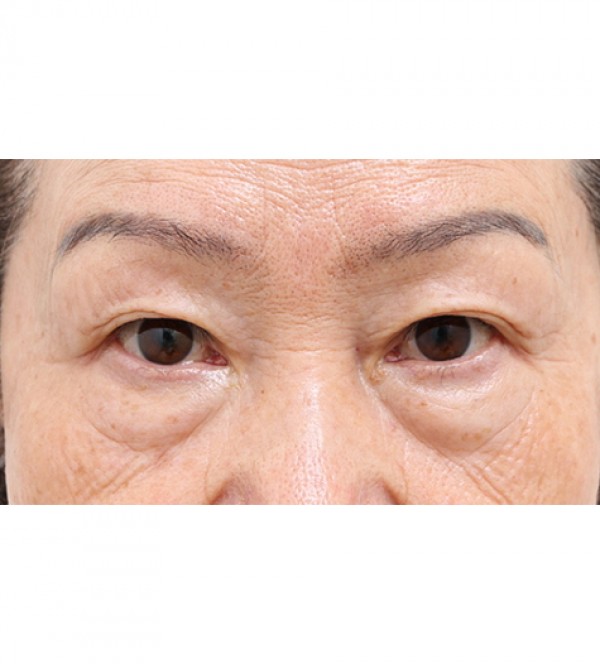 中年眼部整形