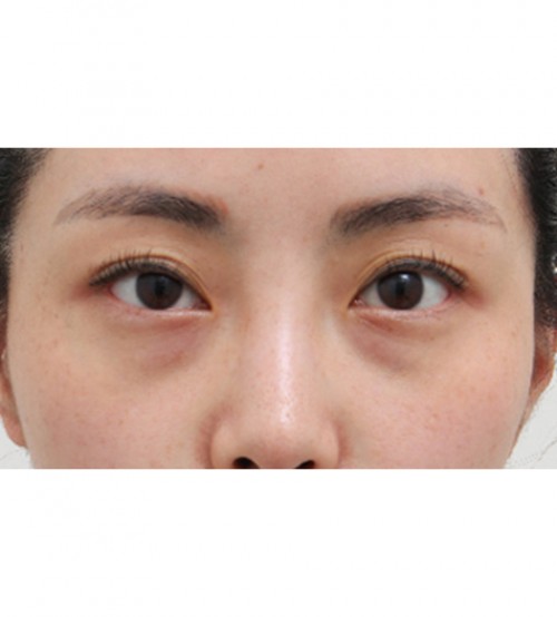 激光 眼底脂肪重置