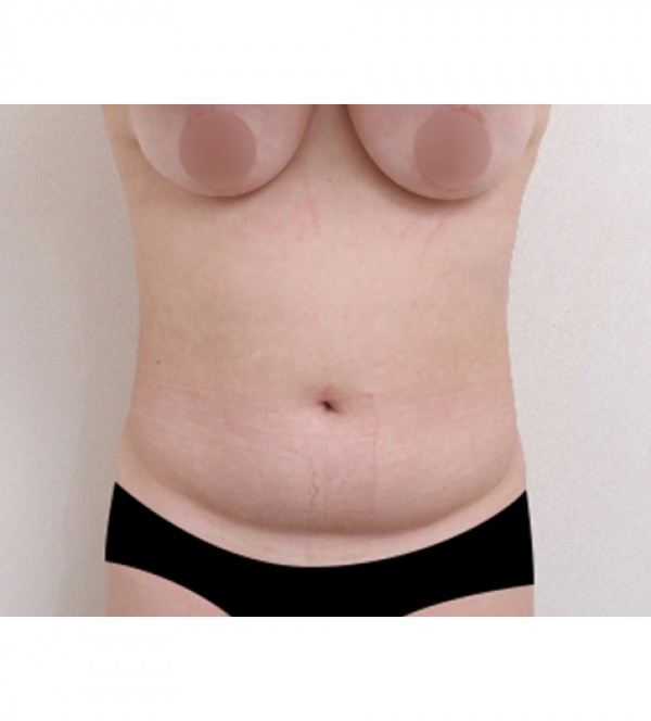 威塑2 身体吸脂