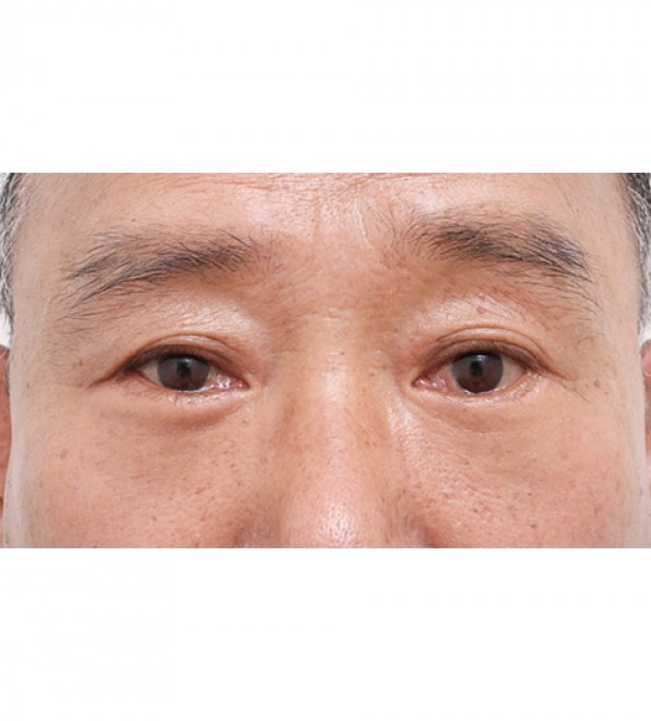 中年眼部整形