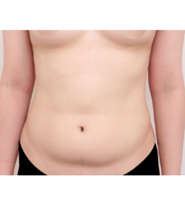 威塑2 身体吸脂