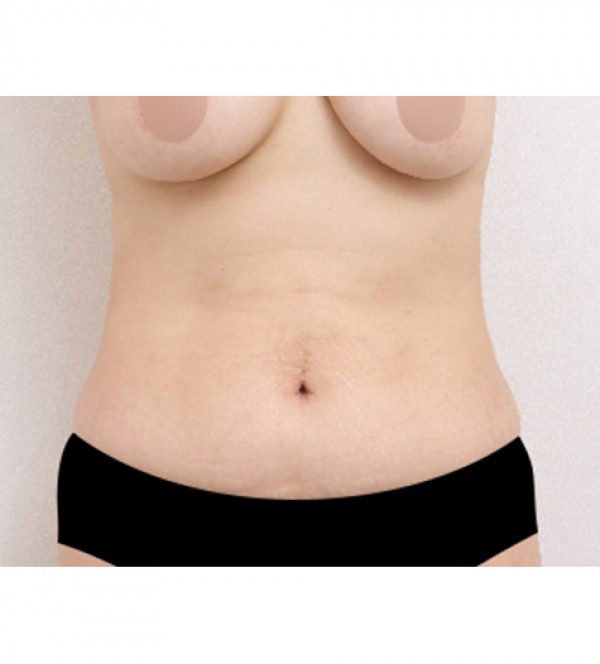 威塑2 身体吸脂