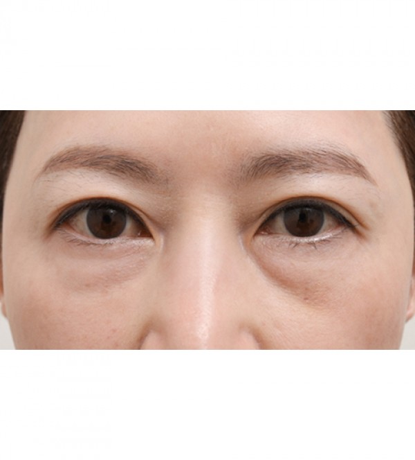 激光 眼底脂肪重…