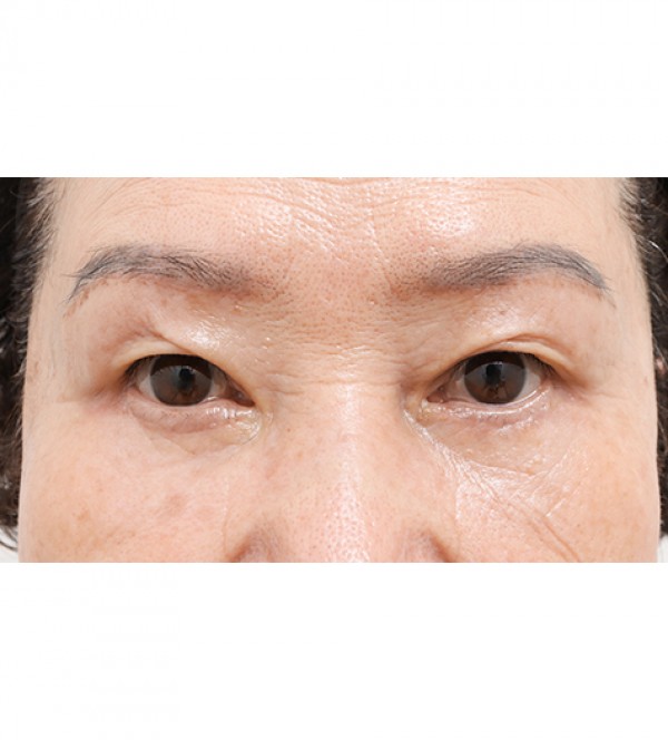 中年眼部整形