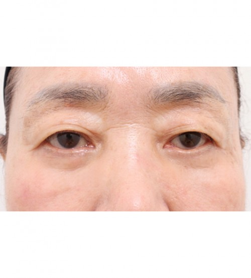 中年眼部整形