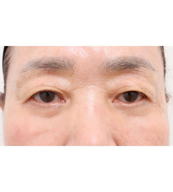 中年眼部整形