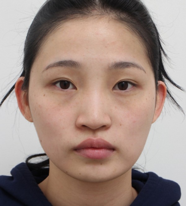 面部脂肪移植