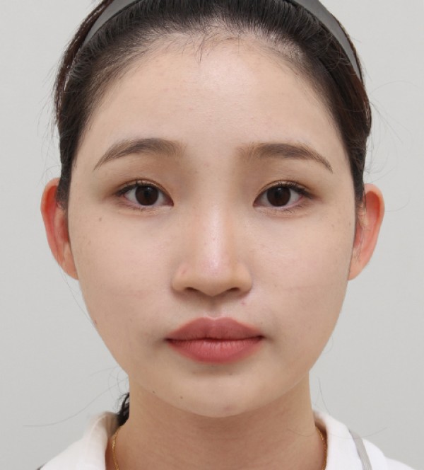 面部脂肪移植