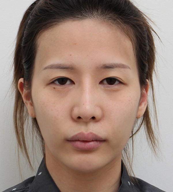 面部脂肪移植