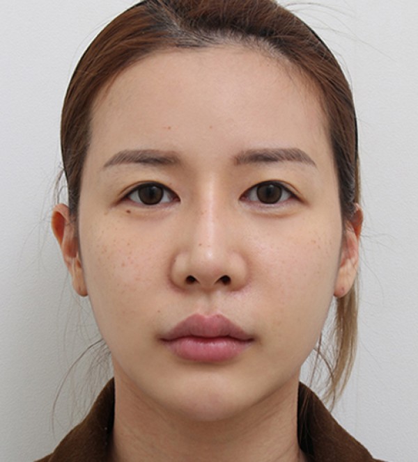 面部脂肪移植
