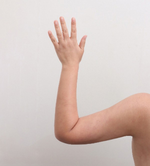 威塑2 身体吸脂