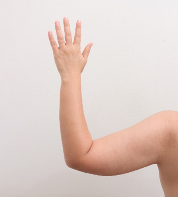 威塑2 身体吸脂