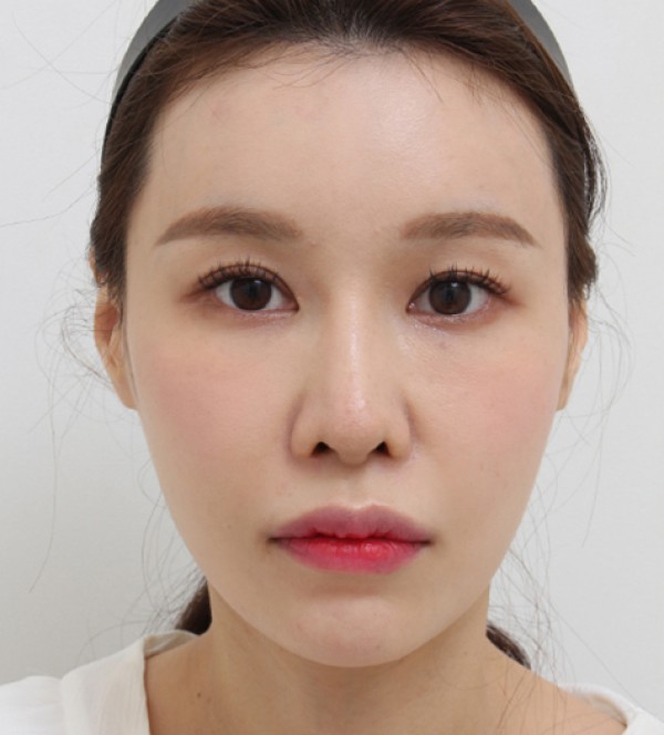 面部脂肪移植