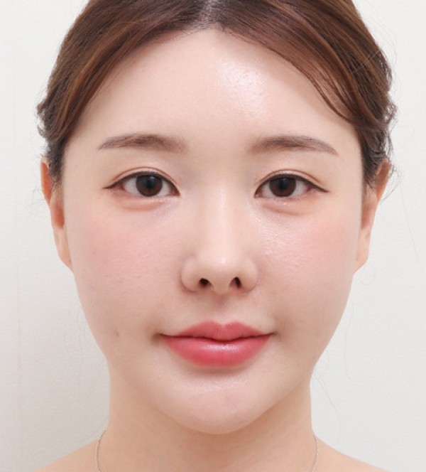 面部吸脂