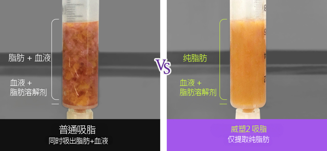 威塑2 身体吸脂