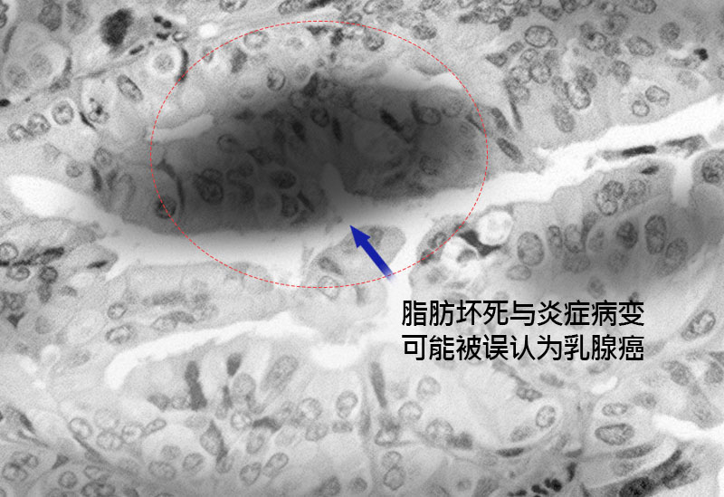 钙化、脂肪囊肿副作用治疗