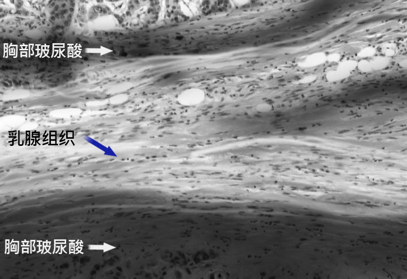 钙化、脂肪囊肿副作用治疗