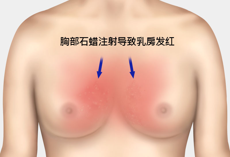 钙化、脂肪囊肿副作用治疗