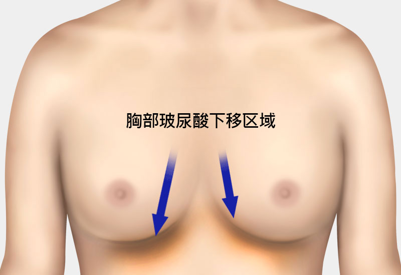钙化、脂肪囊肿副作用治疗