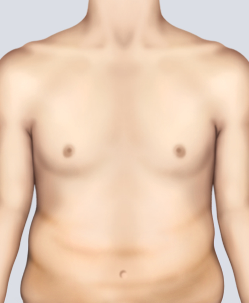 男性乳房发育症