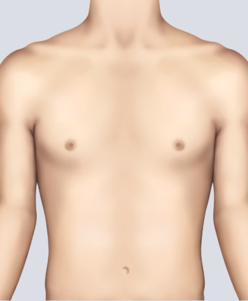 男性乳房发育症