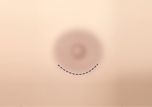 男性乳房发育症
