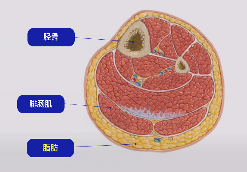 弯腿矫正术